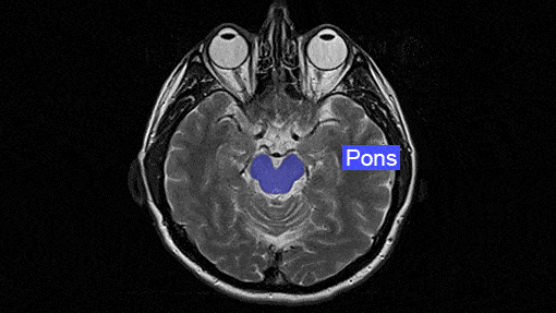 Annotation & Labeling on Brain MRI